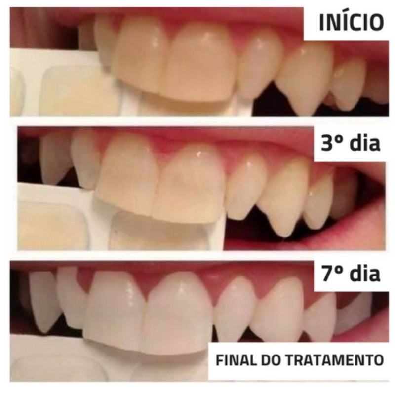Kit Completo para Clareamento Dental - Dentes mais brancos sem Sensibilidade
